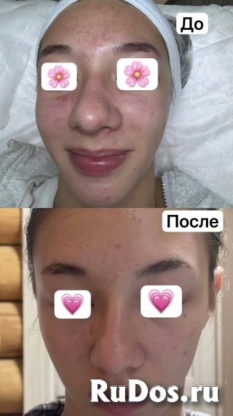 Чистка лица изображение 4