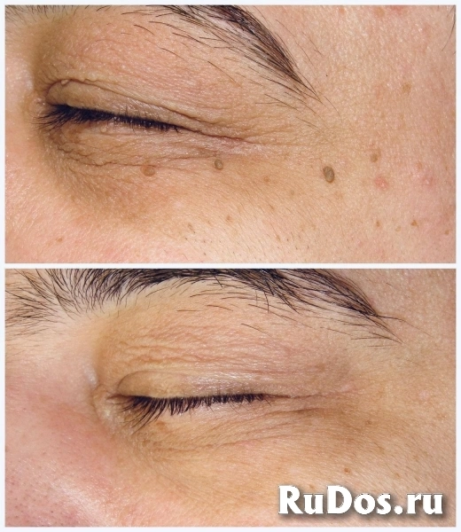 Удаление папиллом в Одинцово изображение 3