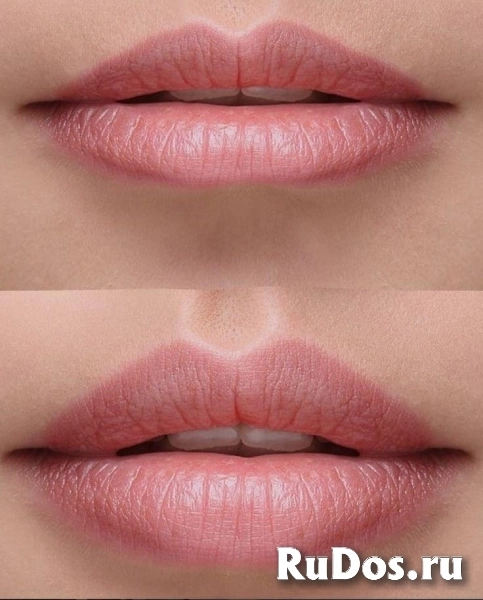 Увеличение губ фото