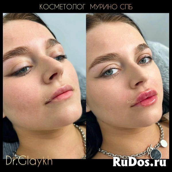 Косметолог - Увеличение губ - Ботокс - Биоревитализация - изображение 9