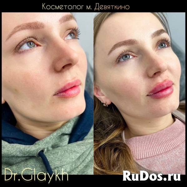 Косметолог - Увеличение губ - Ботокс - Биоревитализация - изображение 4