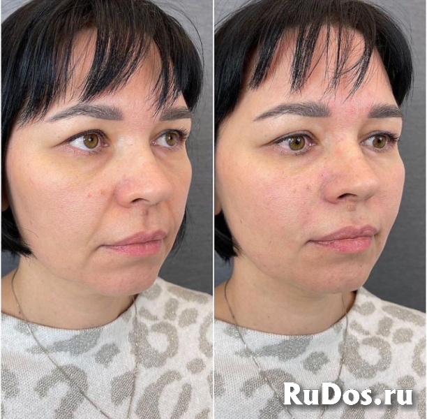 Смас лифтинг, аппаратная подтяжка лица фотка