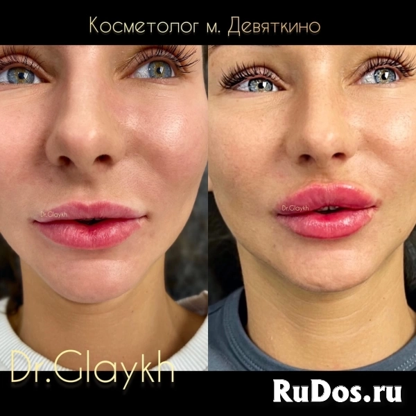 Косметолог - Увеличение губ - Ботокс - Биоревитализация - изображение 7