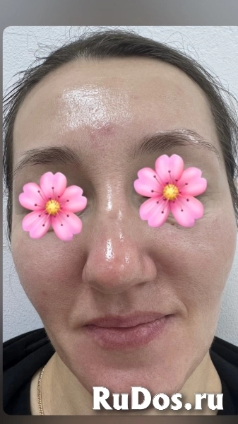 Чистка лица изображение 6