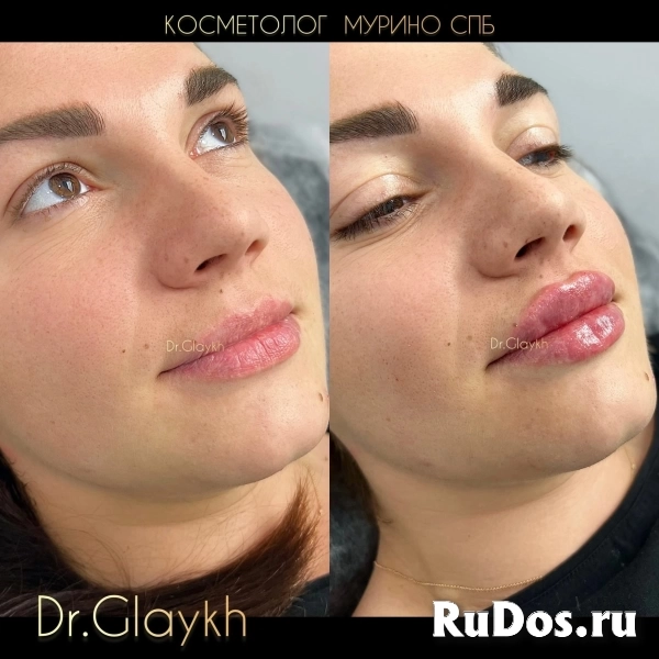 Косметолог - Увеличение губ - Ботокс - Биоревитализация - изображение 8