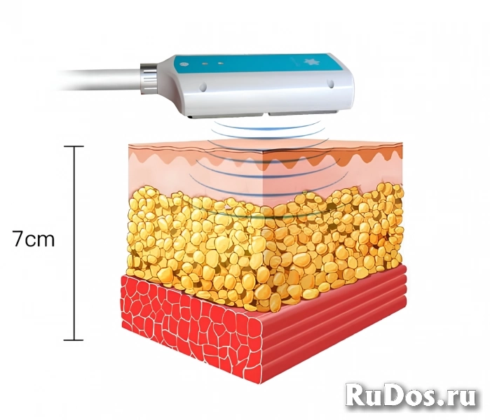 Криополиз - похудение без диет: уберём жировые клетки, восстановим мышцы фотка