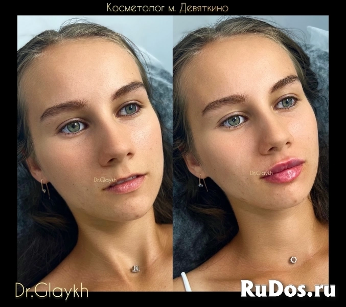 Косметолог - Увеличение губ - Ботокс - Биоревитализация - изображение 10