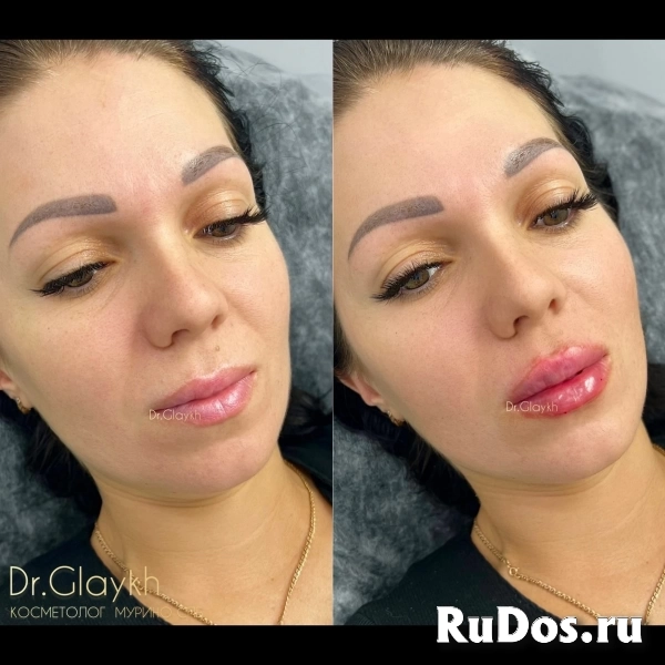 Косметолог - Увеличение губ - Ботокс - Биоревитализация - изображение 5