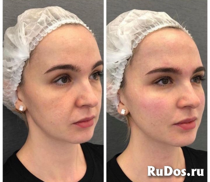 Смас лифтинг, аппаратная подтяжка лица изображение 3