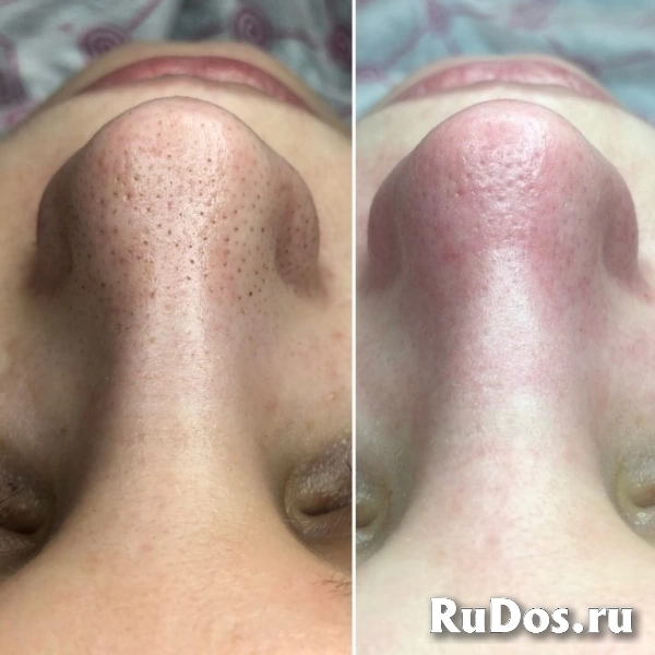 Чистка лица изображение 11