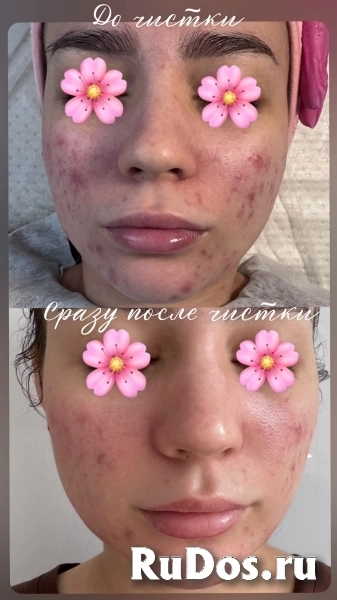 Чистка лица изображение 5