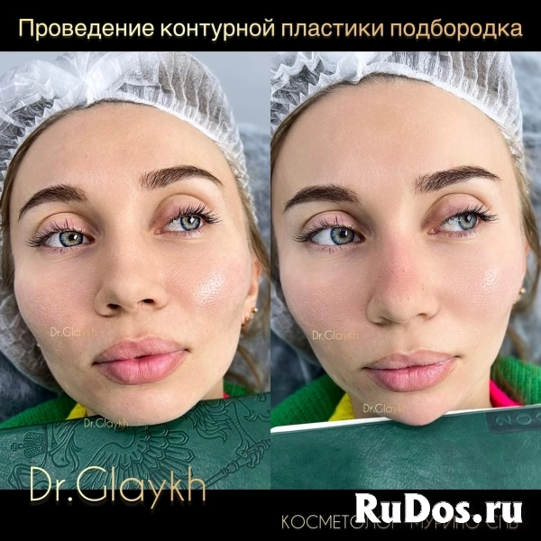 Косметолог - Увеличение губ - Ботокс - Биоревитализация - изображение 3