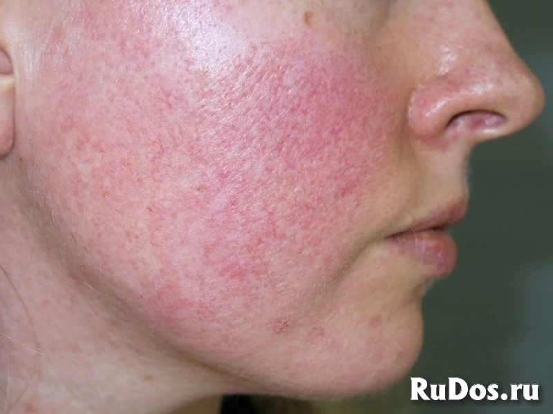 Чистка лица изображение 3