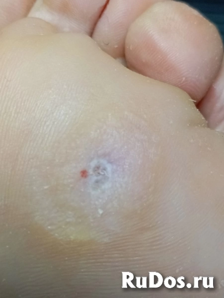 Услуги подолога фотка