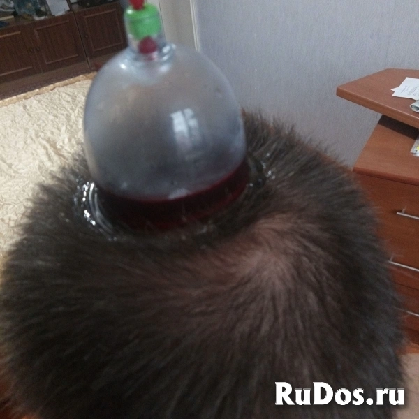 Хиджама здоровье без лекарств изображение 5