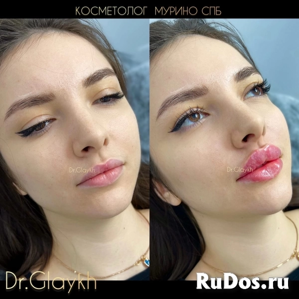 Косметолог - Увеличение губ - Ботокс - Биоревитализация - фотка
