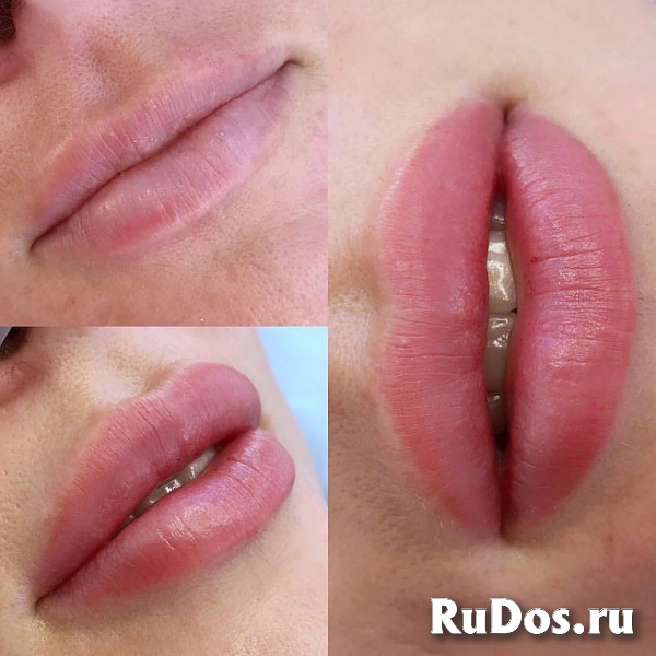 Легендарная пластика губ изображение 5