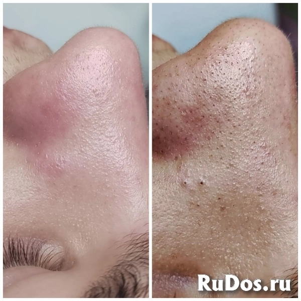 Чистка лица изображение 10