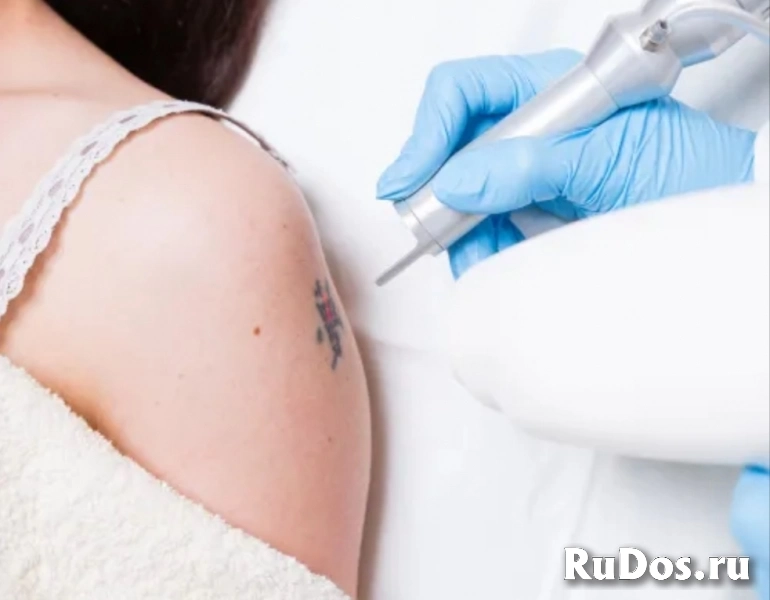 Удаление тату лазером фотка