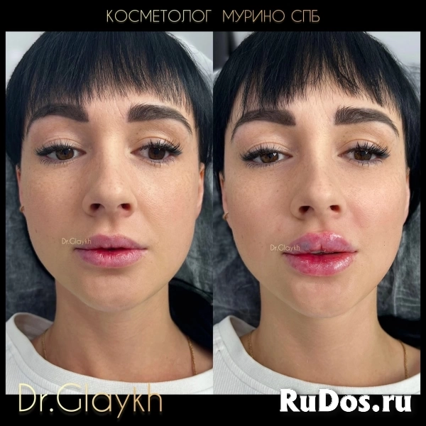 Косметолог - Увеличение губ - Ботокс - Биоревитализация - изображение 6