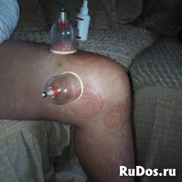 Хиджама здоровье без лекарств фотка