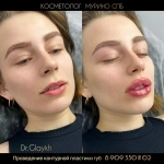 Косметолог - Увеличение губ - Ботокс - Биоревитализация - в объявлении 10 фото Косметолог - Увеличение губ - Ботокс - Биоревитализация - картинка из объявления