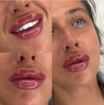 Легендарная пластика губ картинка из объявления