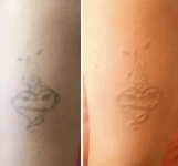 Удаление тату лазером картинка из объявления