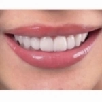 Керамические виниры высочайшего качества в объявлении 1 фото Керамические виниры высочайшего качества картинка из объявления