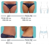 Криополиз - похудение без диет: уберём жировые клетки, восстановим мышцы картинка из объявления