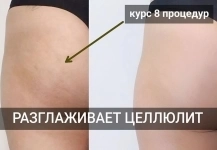 Абонементы: Тело на процедуры LPG массажа. Франция в объявлении 1 фото Абонементы: Тело на процедуры LPG массажа. Франция картинка из объявления