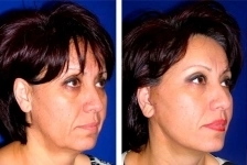 Смас лифтинг — студия перманентного макияжа Натальи Удовиченко в объявлении 3 фото Смас лифтинг — студия перманентного макияжа Натальи Удовиченко картинка из объявления